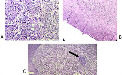 Pathologic response evaluation of localized or locally advanced esophageal carcinoma to induction chemotherapy followed by preoperative concurrent chemotherapy and hypofractionated radiotherapy: a clinical trial